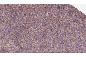 ABIN6273129 at 1/100 staining Human lymph cancer tissue by IHC-P. (KIF12 anticorps  (N-Term))