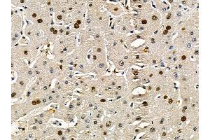 ABIN7095507 and ABIN7099564 at 1/100 staining human liver cancer by IHC-P.
