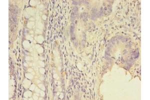 Immunohistochemistry of paraffin-embedded human colon cancer using ABIN7143981 at dilution of 1:100