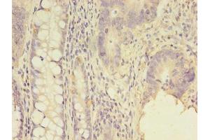 Immunohistochemistry of paraffin-embedded human colon cancer using ABIN7143981 at dilution of 1:100 (SCNN1G anticorps  (AA 90-350))