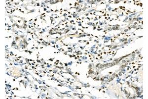 ABIN6261703 and ABIN6277266 at 1/100 staining Human gastric cancer by IHC-P.