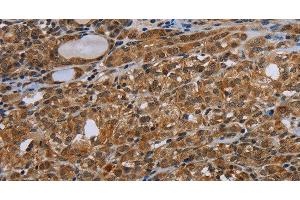 Immunohistochemistry of paraffin-embedded Human thyroid cancer tissue using UHRF2 Polyclonal Antibody at dilution 1:40 (UHRF2 anticorps)