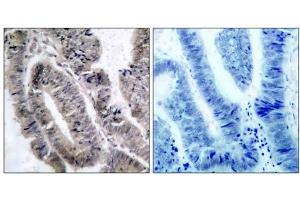 Immunohistochemical analysis of paraffin- embedded human colon carcinoma tissue, using AMPK1/AMPK2 (phospho-Ser485/Ser491) antibody (E011174). (PRKAA1/PRKAA2 anticorps  (pSer485, pSer491))