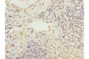 Immunohistochemistry of paraffin-embedded human cervical cancer using ABIN7168321 at dilution of 1:100