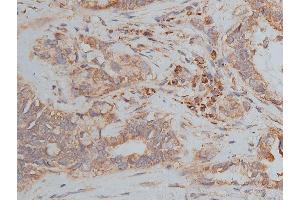ABIN6268647 at 1/50 staining human lung cancer tissue sections by IHC-P. (TSC1 anticorps  (C-Term))