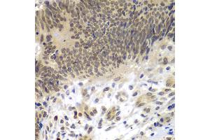 Immunohistochemistry of paraffin-embedded human colon carcinoma using CEBPG antibody (ABIN5974381) at dilution of 1/100 (40x lens). (CEBPG anticorps)