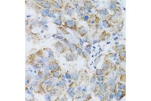 Immunohistochemistry of paraffin-embedded human breast cancer using PSMD10 antibody  at dilution of 1:100 (40x lens).