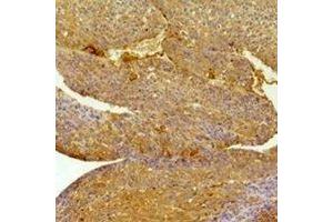 Immunohistochemical analysis of EPHA1 staining in human Hepatocancer,human breast cancer formalin fixed paraffin embedded tissue section.