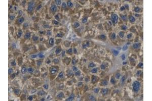 DAB staining on IHC-P; Samples: Human Liver cancer Tissue (CDKN3 anticorps  (AA 1-212))