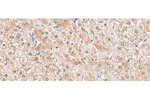 Immunohistochemistry of paraffin-embedded Human liver cancer tissue using HLA-E Polyclonal Antibody at dilution of 1:50(x200) (HLA-E anticorps)
