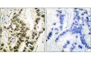Immunohistochemistry analysis of paraffin-embedded human lung carcinoma, using SRF (Phospho-Ser99) Antibody.