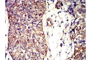Immunohistochemical analysis of paraffin-embedded bladder cancer tissues using APC2 mouse mAb with DAB staining. (APC2 anticorps  (AA 2041-2181))