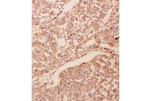 Anti-GDNF antibody, IHC(P) IHC(P): Human Lung Cancer Tissue