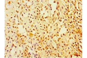 Immunohistochemistry of paraffin-embedded human breast cancer using ABIN7170920 at dilution of 1:100 (SUGCT anticorps  (AA 1-250))