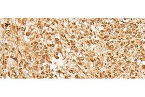 Immunohistochemistry of paraffin-embedded Human liver cancer tissue using JPT2 Polyclonal Antibody at dilution of 1:65(x200) (JPT2 anticorps)