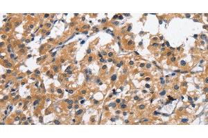 Immunohistochemistry of paraffin-embedded Human thyroid cancer tissue using CLEC2D Polyclonal Antibody at dilution 1:70 (CLEC2D anticorps)