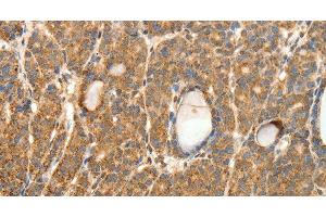 Immunohistochemistry of paraffin-embedded Human thyroid cancer tissue using SYT11 Polyclonal Antibody at dilution 1:30 (SYT11 anticorps)