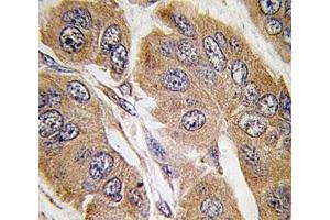 IHC analysis of FFPE human breast carcinoma tissue stained with p70S6K antibody