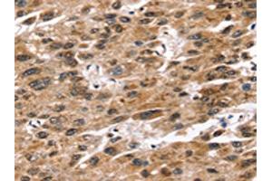 The image on the left is immunohistochemistry of paraffin-embedded Human liver cancer tissue using ABIN7192580(SNTA1 Antibody) at dilution 1/20, on the right is treated with synthetic peptide. (SNTA1 anticorps)