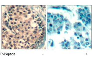 Immunohistochemical analysis of paraffin-embedded human breast carcinoma tissue using HDAC4/HDAC5/HDAC9 (phospho S246/259/220) polyclonal antibody .