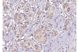 ABIN6274740 at 1/100 staining Human breast cancer tissue by IHC-P. (MRPL40 anticorps  (C-Term))