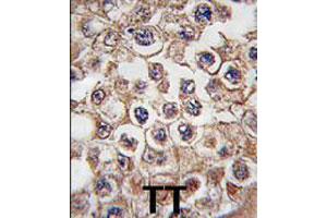 Formalin-fixed and paraffin-embedded human testis tissue reacted with INSRR polyclonal antibody  , which was peroxidase-conjugated to the secondary antibody, followed by DAB staining. (INSRR anticorps  (N-Term))