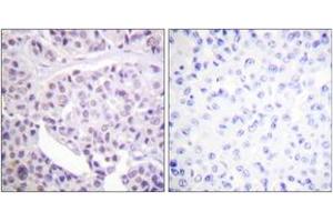 Immunohistochemistry analysis of paraffin-embedded human breast carcinoma tissue, using p53 (Ab-392) Antibody. (p53 anticorps  (AA 344-393))