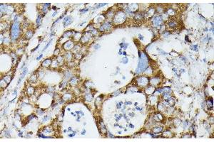 Immunohistochemistry of paraffin-embedded Human colon carcinoma using MTIF2 Polyclonal Antibody at dilution of 1:100 (40x lens). (MTIF2 anticorps)