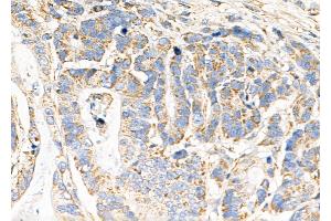 Bcl-2 Antibody at 1/100 staining Human pancreatic cancer by IHC-P.