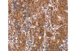 Immunohistochemistry of Human gastric cancer using GUK1 Polyclonal Antibody at dilution of 1:50