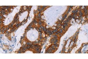 Immunohistochemistry of paraffin-embedded Human colon cancer using GPA33 Polyclonal Antibody at dilution of 1:30 (GPA33 anticorps)