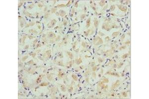 Immunohistochemistry of paraffin-embedded human gastric cancer using ABIN7146127 at dilution of 1:100 (CXCL14 anticorps  (AA 35-111))