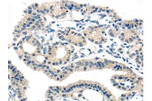 The image on the left is immunohistochemistry of paraffin-embedded Human thyroid cancer tissue using ABIN7192395(SLC16A11 Antibody) at dilution 1/25, on the right is treated with synthetic peptide. (SLC16A11 anticorps)
