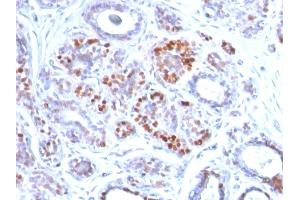 Formalin-fixed, paraffin-embedded human Breast Carcinoma stained with GATA-3 Mouse Monoclonal Antibody (GATA3/2442).