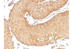 Formalin-fixed, paraffin-embedded human Ovarian Carcinoma stained with Calcineurin A Mouse Monoclonal Antibody (CALNA/2353).