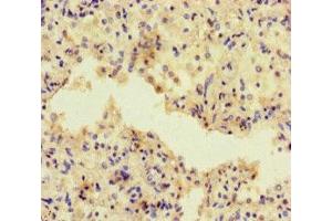 Immunohistochemistry of paraffin-embedded human lung cancer using ABIN7143320 at dilution of 1:100 (ADCY1 anticorps  (AA 416-610))