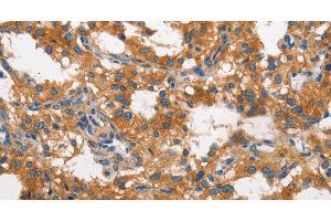 Immunohistochemistry of paraffin-embedded Human thyroid cancer using CLTC Polyclonal Antibody at dilution of 1:60