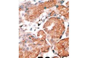 Formalin-fixed and paraffin-embedded human cancer tissue reacted with the primary antibody, which was peroxidase-conjugated to the secondary antibody, followed by DAB staining.