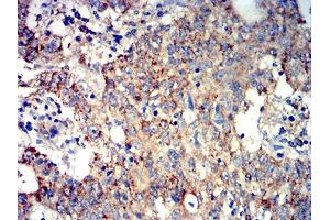 Immunohistochemical analysis of paraffin-embedded stomach cancer tissues using ATG3 mouse mAb with DAB staining. (ATG3 anticorps  (AA 1-100))