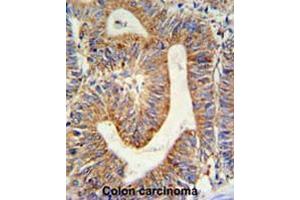 RPL17 Antibody (C-term) IHC analysis in formalin fixed and paraffin embedded colon carcinoma followed by peroxidase conjugation of the secondary antibody and DAB staining.