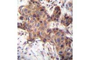 Immunohistochemistry analysis in formalin fixed and paraffin embedded human breast carcinoma reacted with GDF9 Antibody (N-term) followed by peroxidase conjugation of the secondary antibody and DAB staining. (GDF9 anticorps  (N-Term))