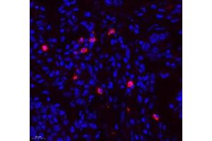 Immunofluorescence of paraffin embedded human lung cancer using TEAD3 (ABIN7075852) at dilution of 1: 700 (400x lens) (TEAD3 anticorps)