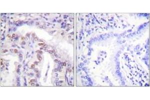Immunohistochemistry analysis of paraffin-embedded human lung carcinoma, using SENP6 Antibody. (SENP6 anticorps  (AA 1042-1091))