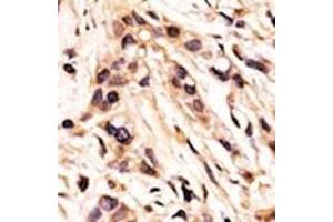 Formalin-fixed and paraffin-embedded human cancer tissue reacted with the primary antibody, which was peroxidase-conjugated to the secondary antibody, followed by AEC staining. (Retinoblastoma 1 anticorps  (pSer608))