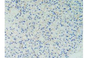 IHC-P analysis of Human Kidney Cancer Tissue, with DAB staining. (PODXL anticorps  (AA 220-431))