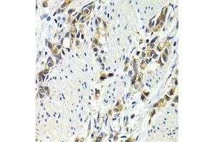 Immunohistochemistry of paraffin-embedded human stomach cancer using WNT3A antibody at dilution of 1:200 (400x lens). (WNT3A anticorps)