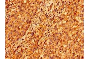 Immunohistochemistry of paraffin-embedded human colon cancer using ABIN7146306 at dilution of 1:100