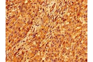 Immunohistochemistry of paraffin-embedded human colon cancer using ABIN7146306 at dilution of 1:100 (ORAI1 anticorps  (AA 1-87))