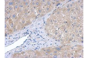IHC-P Image Immunohistochemical analysis of paraffin-embedded human hepatoma, using Creatine kinase (brain) antibody, antibody at 1:500 dilution. (CKB anticorps)