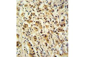 Formalin fixed and paraffin embedded human breast carcinoma reacted with DDX49 Antibody (C-term) followed by peroxidase conjugation of the secondary antibody and DAB staining. (DDX49 anticorps  (C-Term))